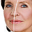 antifalten-botox