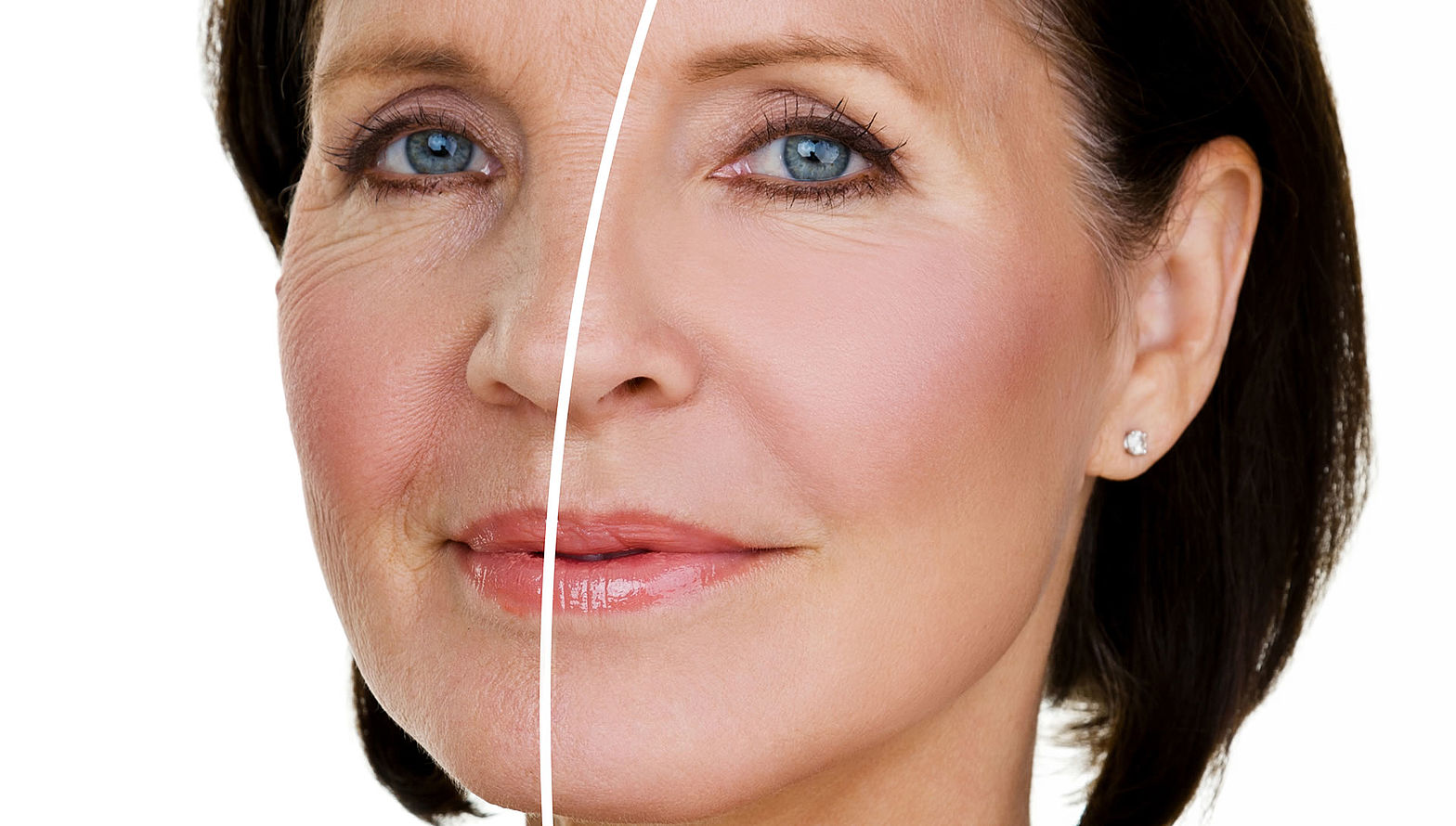 antifalten-botox
