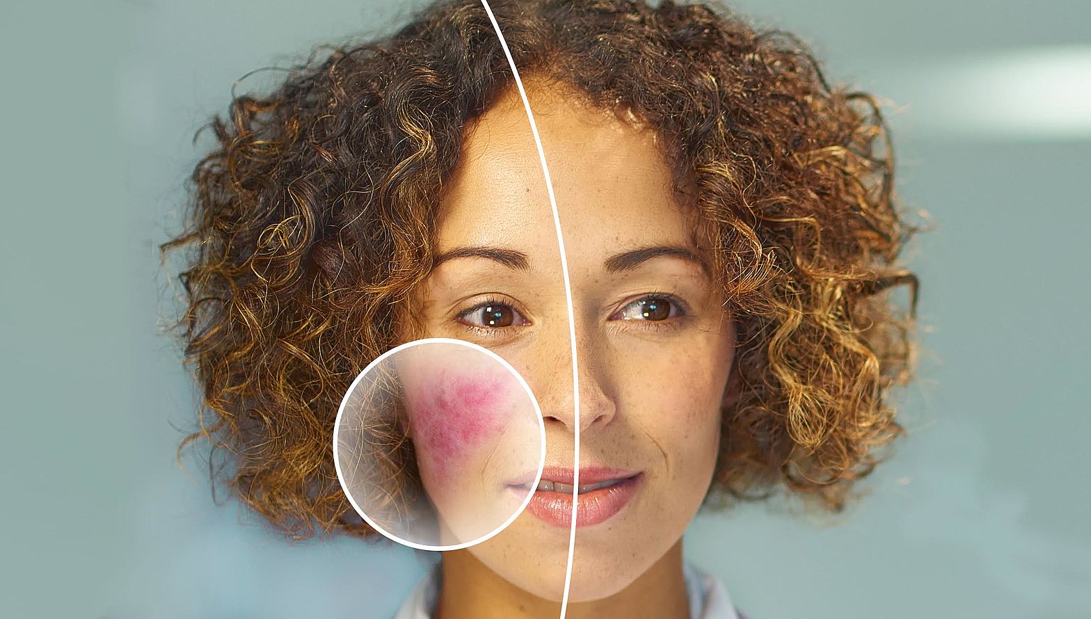rosacea